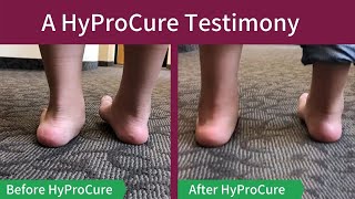 Meet Hector - How HyProCure Surgery Corrected Hyperpronation