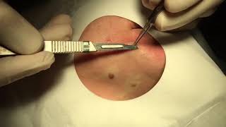 Mole Removal - Bodyworx Medical Center