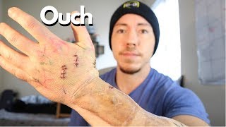 FTM Phalloplasty I'm a Mess | Post-op update