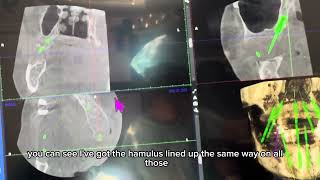 Pterygoid Implant Placement with Jonathan Bullard DMD DABOI
