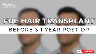 Before and After Results: 1 Year Post FUE Hair Transplant