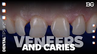 Veneers and caries treatment: two approaches