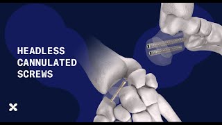 The Auxein Headless Cannulated Screw System delivers precision, stability, and surgical confidence.