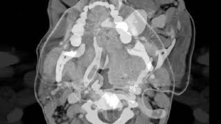 Parapharyngeal Abnormality: CTscan to "Bizet" - Toreador Song, from Opera "Carmen"