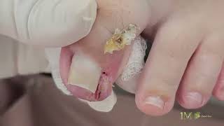 5 YEARS SUFFERING INGROWN TOENAIL – I FIXED IT#satisfying #viral