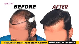 Hair Transplant with 4500 Grafts Changed My Life!