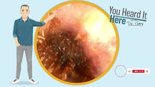 Emergency Ear Wax Removal: The "Solid Wall" Breakthrough! VLOG #136