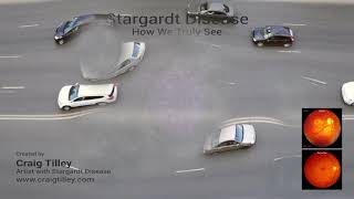 Stargardt Disease - Macular Degeneration - How We See - Blind Spots, Warps, Speckles, Kaleidoscopes
