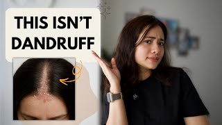 Seborrheic Dermatitis on Scalp? Try This Scalp Routine (Hint: It Works!)