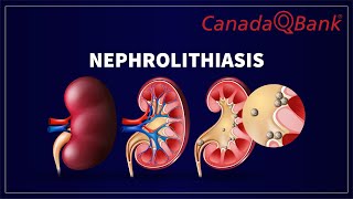Nephrolithiasis: Causes, Symptoms, Diagnosis & Treatment | CanadaQBank