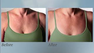 SilcSkin Decollette pads are designed to correct and prevent chest wrinkles whilst you sleep