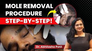 Live Mole Removal Procedure Using Radiofrequency | Watch the Full Process! | Clear Skin Clinic, Pune