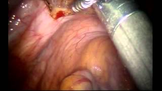 Robotic Excision of Endometriosis Using CO2 Laser Fiber System