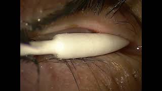 Eyelid expression after Intense Pulsed Light: What is normal and what is abnormal?