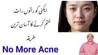 Home Remedy For Acne | How To Get Rid Of Acne Overnight