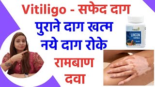 Eliminate Vitiligo white spots from the root. Prevent new spots from appearing. Why do white spot...
