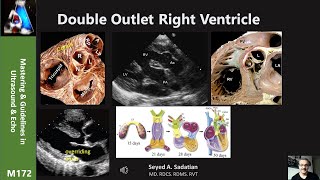 Double Outlet Right Ventricle (DORV)
