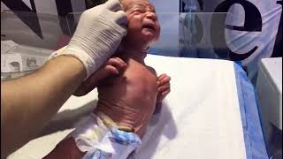 Meconium (MSL) Baby Care After C-Section | NICU Cleaning & Management