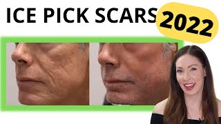 New Method To Get Rid Of Ice Pick Scars In 2022