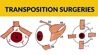 Transposition Surgeries in Strabismus