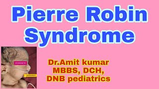 # Pierre_robin_syndrome #micrognathia #retrognathia #glossoptosis