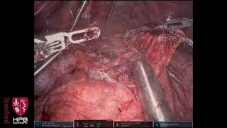 Robotic central pancreatectomy with pancreatogastrostomy + enucleation of pancreatic head tumor