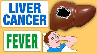 Liver Cancer and Fever