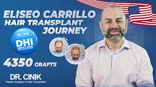Eliseo Carrillo | DHI 4350 Grafts| Hair Transplant Journey | Dr. Cinik Hospital