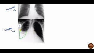 Community Acquired Pneumonia for USMLE Step 2