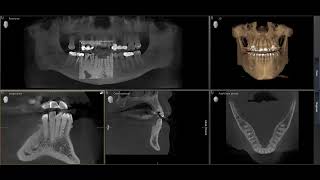 Tip of the Day: Make a PA from CBCT