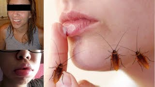 How To Treat The Cockroach Bite On Lip