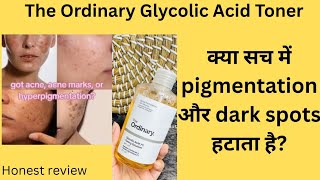 "The Ordinary Glycolic Toner Review in Hindi | Pigmentation पर असर? + Best Affordable Indian Toners"